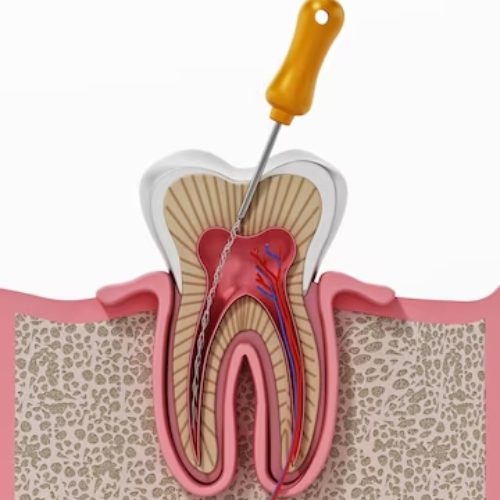 Root Canal Treatment Cost In Hyderabad