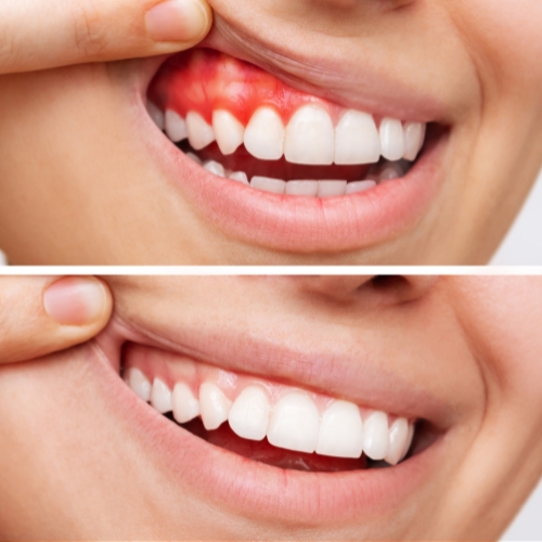 Treatment Of Gum Diseases in Hyderabad